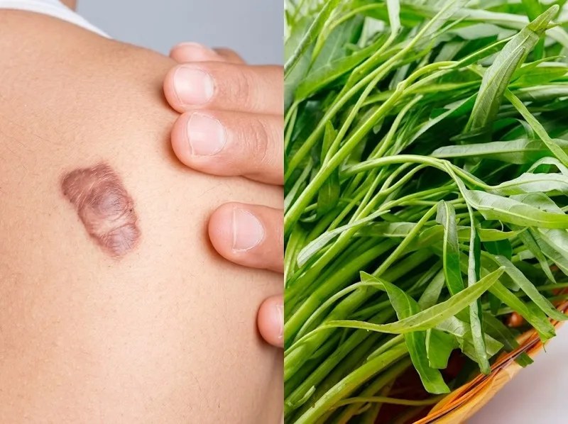 Chưa có bằng chứng chắc chắn gạo nếp và rau muống gây sẹo lồi
